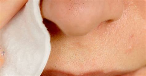 Remove Blackheads With One Simple And Effective Trick Healthy Food Remedy