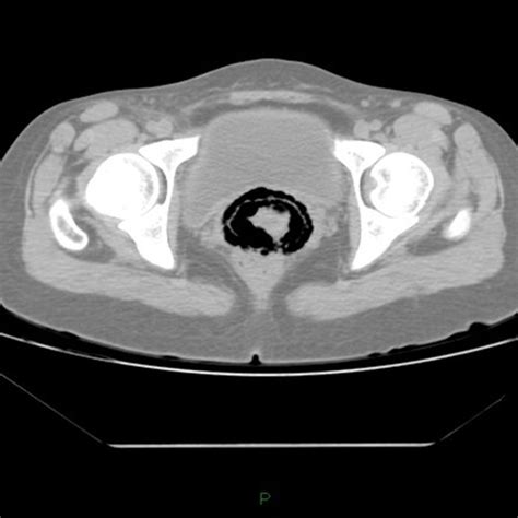 Pelvic Computed Tomography We Can See Multiple Gas‐filled Cysts In The