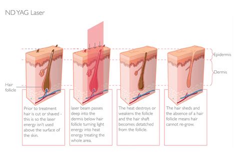 The laser pubic hair removal treatment aims at removing the pubic hair. Laser Hair Removal - Parfaire Clinic