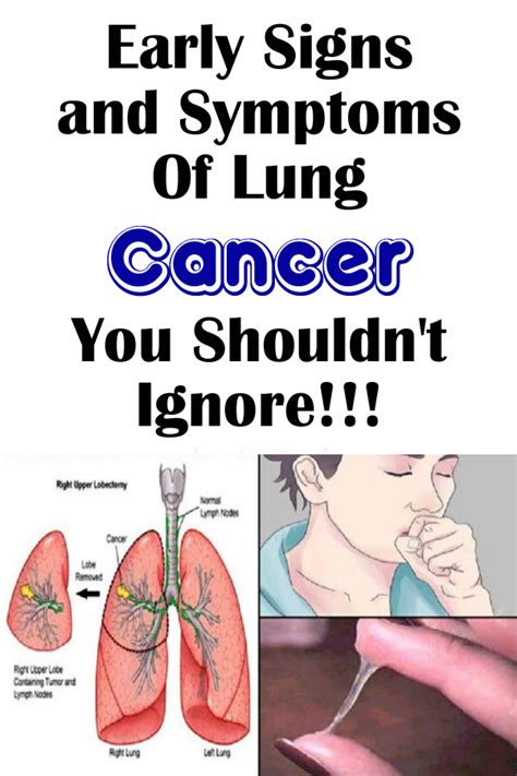 Top Lung Cancer Signs