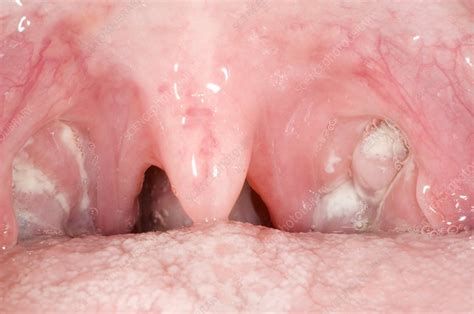 Tonsillitis Stock Image C Science Photo Library