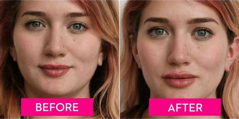 A Guide To Lip Injections From The Cost To How They Feel Before And After Lip Fillers