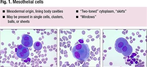 Fluid Cytology—key Features And Ancillary Testing Cap Today