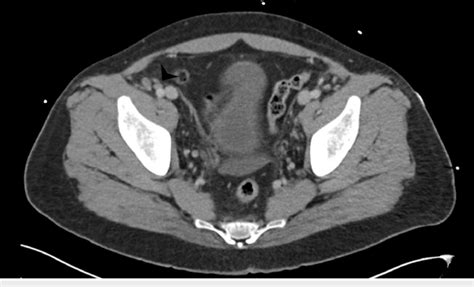 Ct Abdomen And Pelvis With Iv Contrast Demonstrating A 13 X 08 Cm