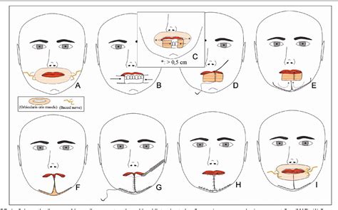 Figure 1 From Reconstruction Of Lower Lip With Myomucosal Advancement