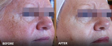 Lumecca Rosacea Treatment Aspire Clinic