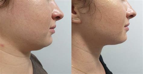 How To Lose Under Chin Fat Change Comin