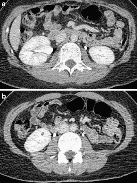 A And B Axial Post Contrast Images From A Contrast Enhanced Ct Scan