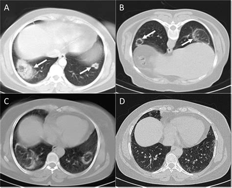 Follow Up Ct Scans In Organizing Pneumonia A The Initial Chest Ct