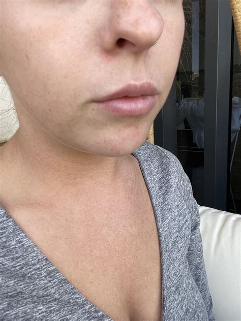 How Can I Fix Red Scaring Left From Perioral Dermatitis Around Nose