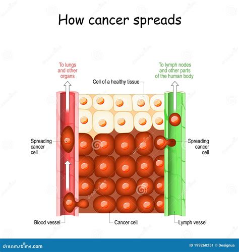 How Cancer Spreads Stock Vector Illustration Of Immune 199260251