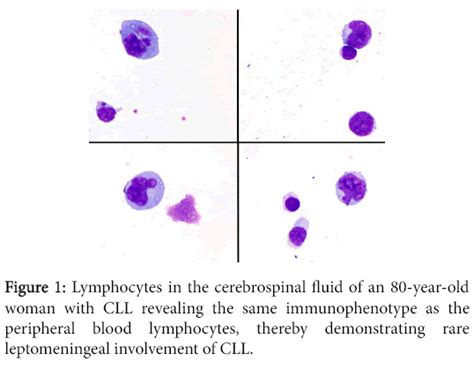 Chemotherapy Open Access Lymphocytes Cerebrospinal Fluid