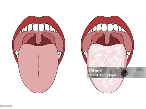 Normal Tongue Coating