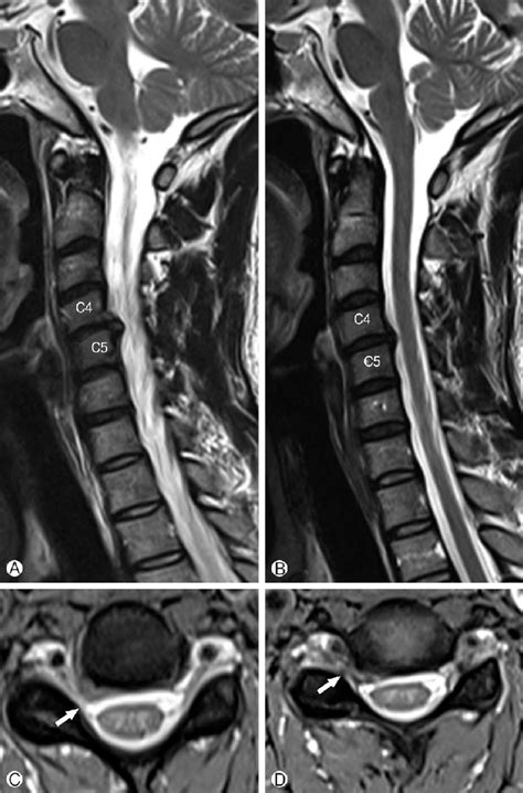 Initial Mri Study T2 Weighted Image Of The Cervical Spine A