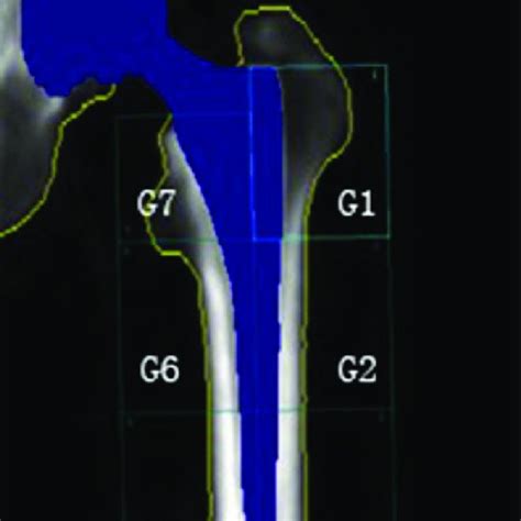 Gruen Zones Used In Dual Energy X Ray Absorptiometry Dexa Download