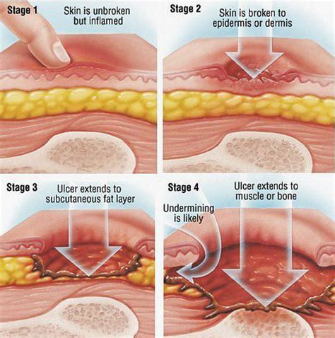 Medivisuals Stages Of Sacral Decubitus Ulcer Medical Illustration The