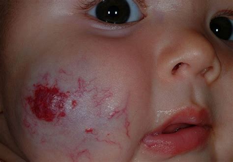 strawberry birthmarks on the cheek birthmark face pictures fx makeup