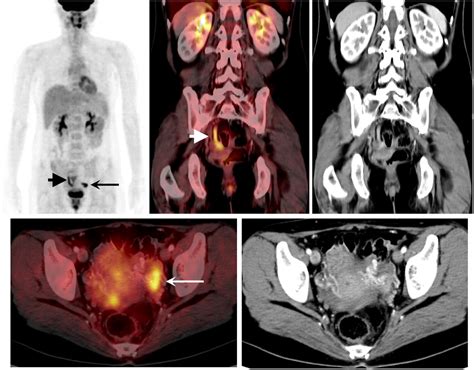 Physiologic 18f Fdg Uptake In The Fallopian Tubes At Mid Cycle On Pet