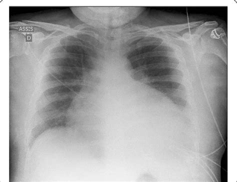 Chest X Ray Shows Cardiomegaly With Bilateral Hilar Congestion
