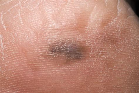 Types Of Skin Cancer And How To Spot Them Jerseys Best