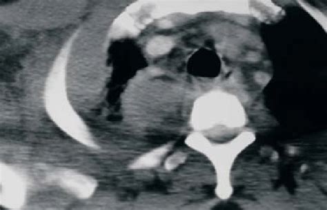 Computed Tomography Of The Chest Revealing Loculated Pleural Empyema