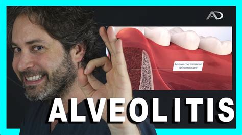 Como Puedes Prevenir La Alveolitis Infeccion Despues