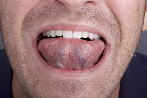 Normal Under Tongue