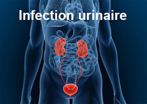 Infection Urinaire Chez Lhomme Symptômes Traitement Définition