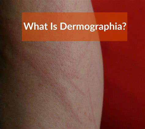 Dermographia Dermographism Causessymptomstreatment Urticaria