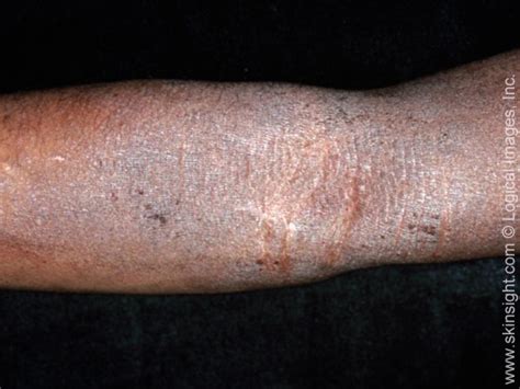 Dermatitis Atopica National Eczema Association