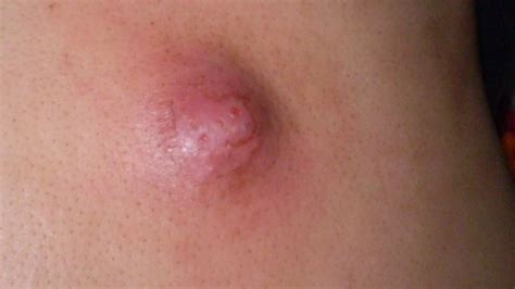 Infected Sweat Gland In Armpit Groin Causes Pictures Treatment Home. 