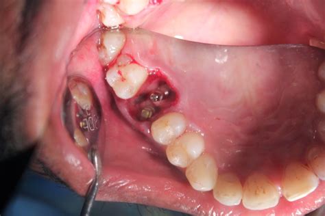 Upper Decayed Molar Extraction And Implant Placement