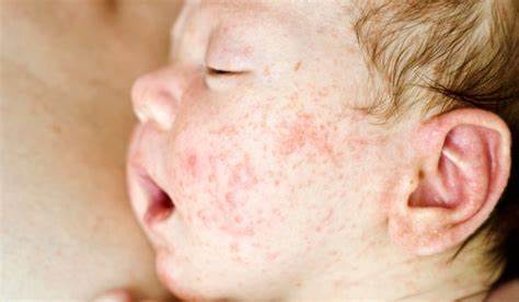 Аллергический дерматит какая диета Атопический дерматит у детей: лечение, фото, причины, симптомы Атопический дерматит у детей: лечение, фото, причины, симптомы Аллергический дерматит какая диета