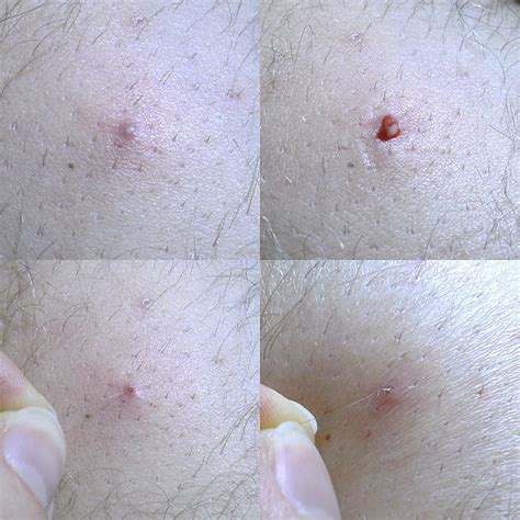 Ingrown Hair Symptom Treatment And Prevention Md