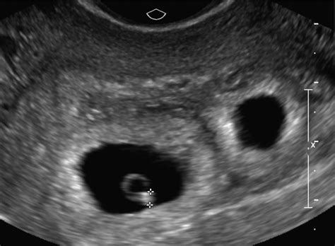 Transvaginal Ultrasound At 5 Weeks And 6 Days Of Gestation