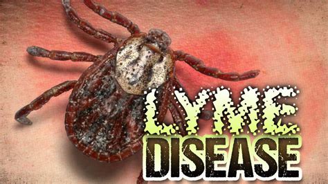 Human Cases Of Tick Borne Lyme Disease Explode In Michigan