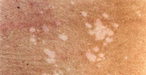 Fungal Skin Cancer
