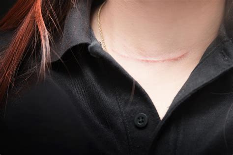 What To Know About Laser Treatment For Scars Vipps Clinic