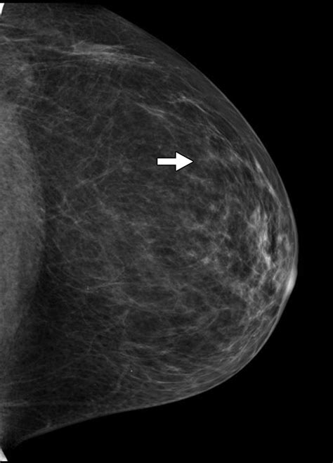 Breast Calcifications The Focal Group Ajr