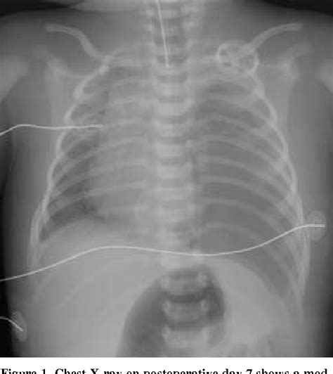Figure 1 From Chylothorax After Repair Of Congenital Diaphragmatic