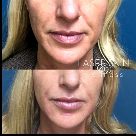 Facial Fillers Palm Beach Gardens And Lake Worth Fillers Near Me Facial Fillers Dermal