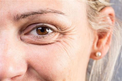 Understanding The Causes And The Best Treatment For Under Eye Wrinkles