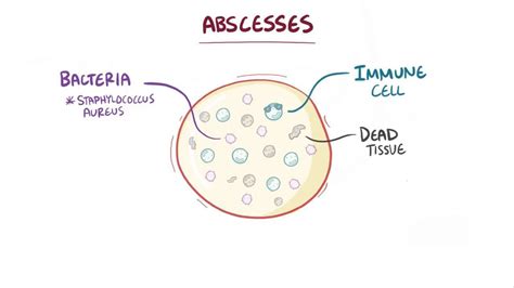 How To Describe An Abscess In Medical Terms