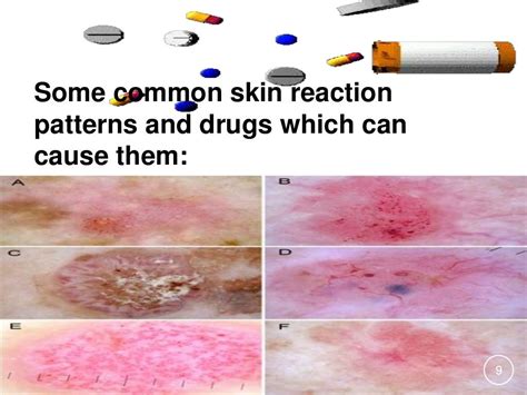 Drug Induced Skin Disorders