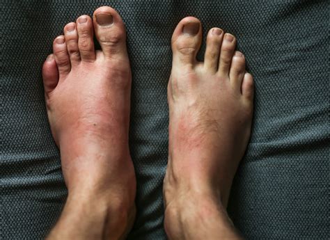 Can Leggings Cause Rash On Legs And Feet
