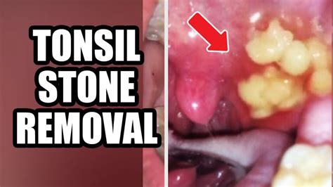 Tonsils Stone Removal Causes And Treatment 2021 Youtube