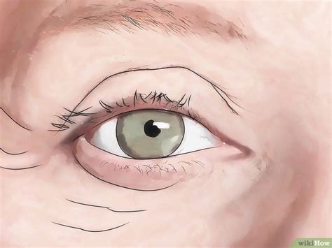 How To Know If You Have Eye Mites Symptoms And Treatments