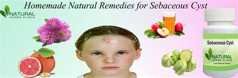 Homemade Natural Remedies For Sebaceous Cyst