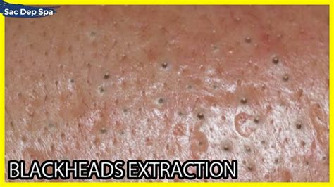 Big Cystic Acne Blackheads Extraction Blackheads Milia Sac Dep Spa