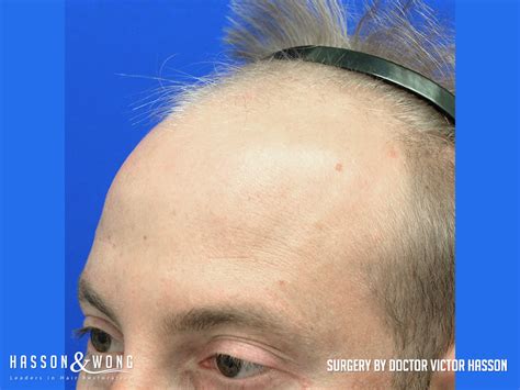 We provide the best hair transplant results with the method of fue, fut, and bht method. FUE Hair Transplant Before & After | 4210 FUE Grafts ...